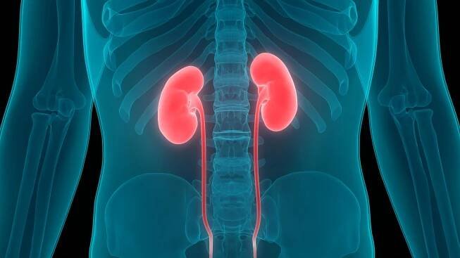 Wilms Tumor: MedlinePlus
