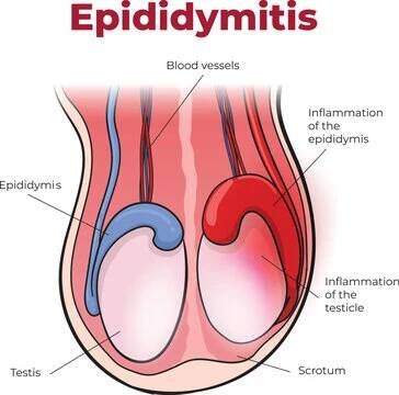DVT signs and symptoms diagram