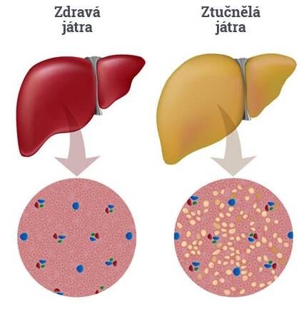 5 příznaků, že vaše játra nejsou v pořádku