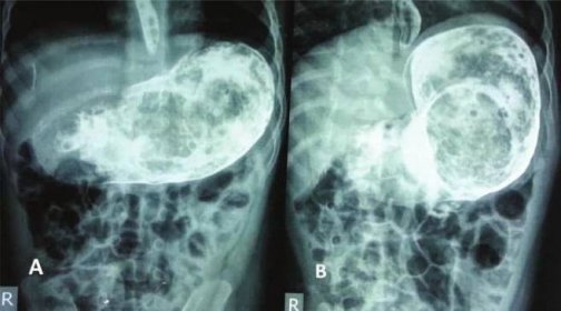 X-ray žaludku, který ukazuje