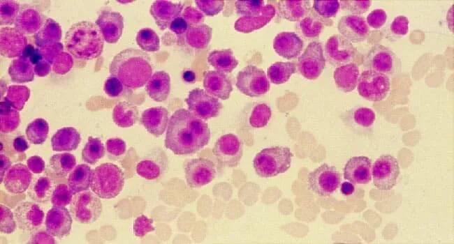 Multiple Myeloma - Symptoms, Causes, Stages, Basics