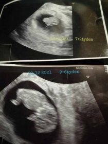 Těhotenství | Utz 7+3 týden těhotenství