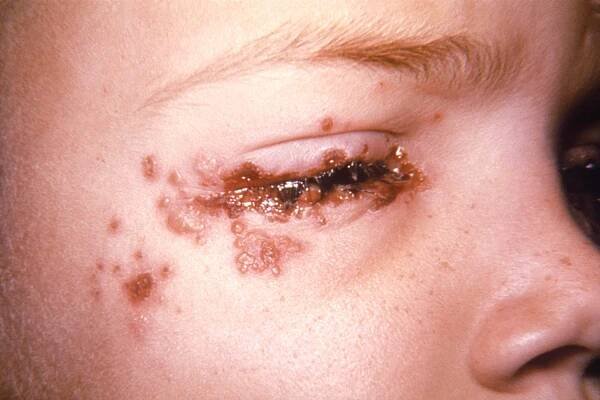 Herpetic keratitis, around the eye of a child