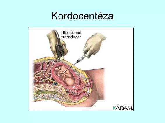 Kordocentéza 