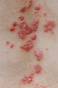 Pohled na záda ženy s dermatitidou problém vyrážky a svědění suché kůže. — Stock obrázek
