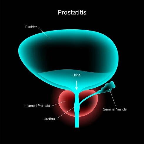 Prostatitis - Dr Ben Medical - Men's Health Singapore GP Clinic