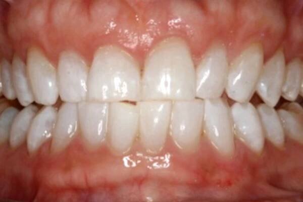 Seeing is Believing - Amazing KöR Whitening Results