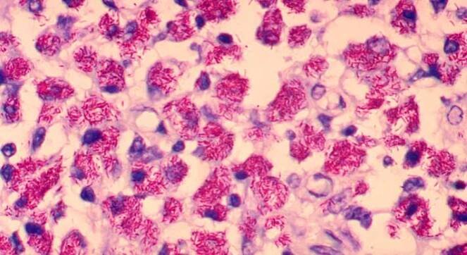 The Cause Of Autoimmune Diseases Like Rheumatoid Arthritis Could Be In Your Fridge | IFLScience