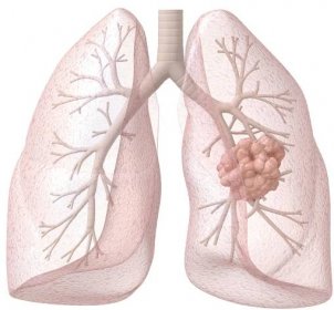 Adiktolog o závažných následcích kouření: Rakovinou plic výčet nekončí. Co způsobuje cigaretový kouř?