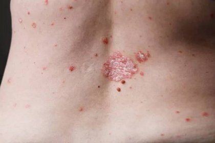 Zadní pohled na ženy s problémem dermatitida vyrážku a svědění suché kůže. Kožní ekzém — Stock obrázek