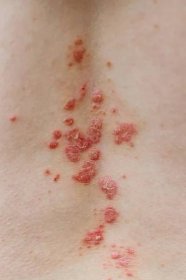 Psoriáza vulgaris kůže. Psoriáza je autoimunitní onemocnění, které postihuje kůži způsobit zánět kůže červené a šupinaté. Ekzém a další kožní stavy jako plíseň, plak, vyrážka a náplasti — Stock obrázek
