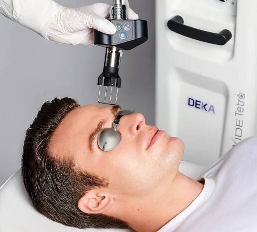 Frakčný resurfacing tváre (co2 laser resurfacing)