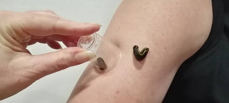 Hirudologie, aplikace pijavice lékařské.