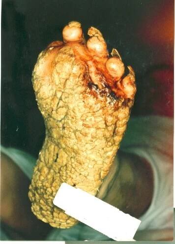 Palmoplantar keratoderma - Wikipedia