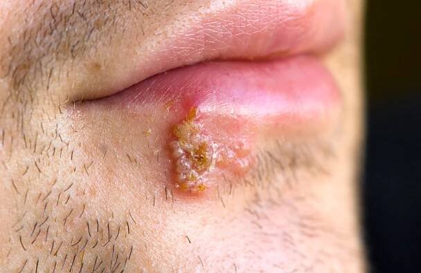 Herpes