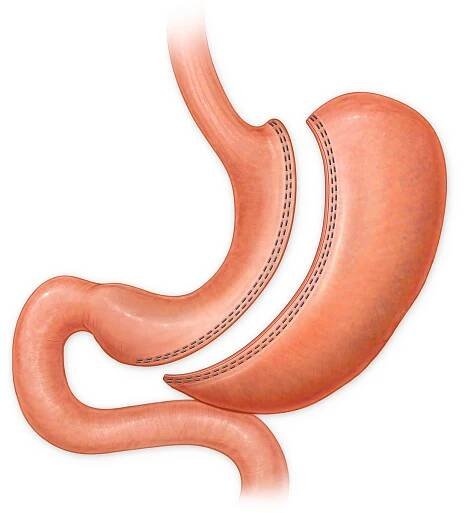 Sleeve Gastrectomy