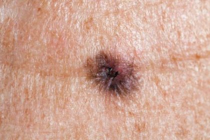 lékařské: lentigo maligna melanoma - melanom - stock snímky, obrázky a fotky