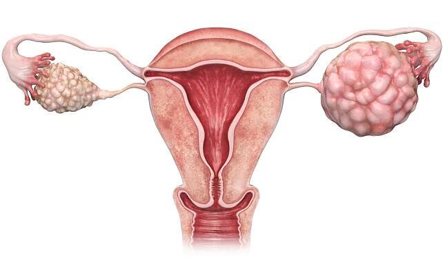 PCOS
