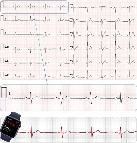 Svod I: 12 svodové EKG vs EKG hodinky