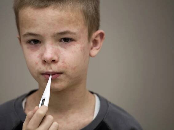 Florida Measles Outbreak Grows as New Case Reported
