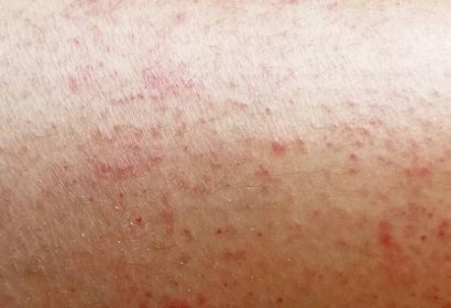 Vyrážka na citlivou kůži nebo kožní problémy s alergii vyrážka — Stock obrázek