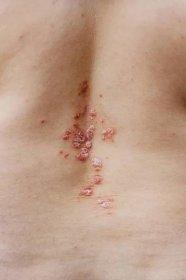 Pohled na záda ženy s dermatitidou problém vyrážky a svědění suché kůže. — Stock obrázek