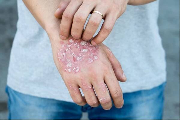 Lupénkou neboli psoriázou trpí v Česku kolem 300 tisíc pacientů