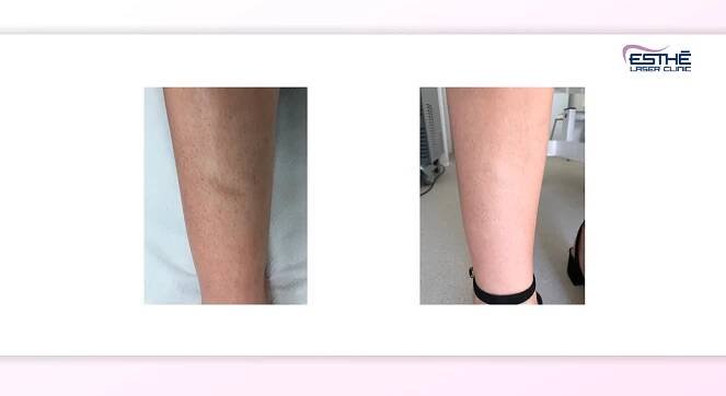 Odstranění jizev a strií | Esthé Laser Clinic