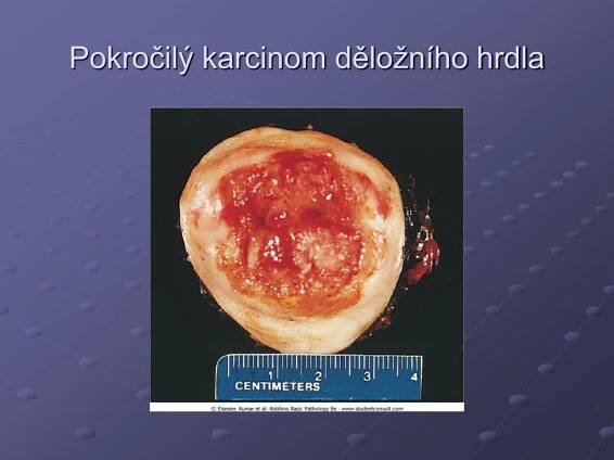 PPT - Gynekopatologie PowerPoint Presentation - ID:433081