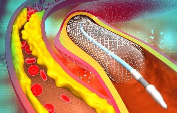 stent koronární tepny - stenty - stock snímky, obrázky a fotky