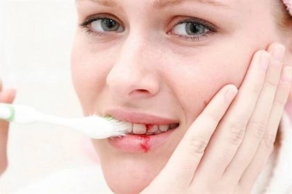 Krvácení dásní může přerůst v parodontitidu. Jak se mu vyhnout?