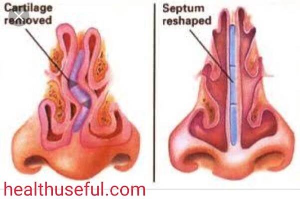 What is Septoplasty | Septoplasty Procedure, Risks, and Recovery