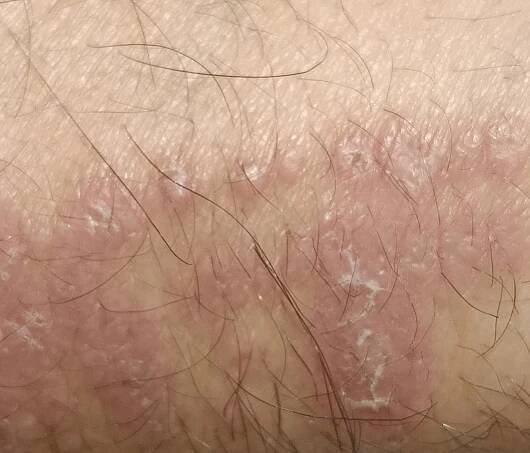 Skin mycoses (ICD10: B35-B49) - Online consultation AI dermatologist
