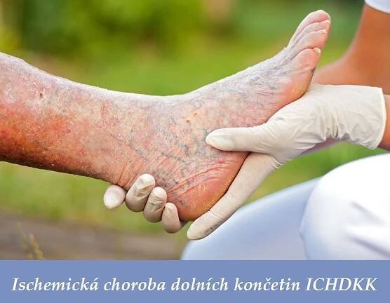 Ischemická choroba dolních končetin, ICHDKK - příznaky, projevy, symptomy
