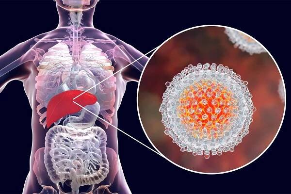 Hepatitis C