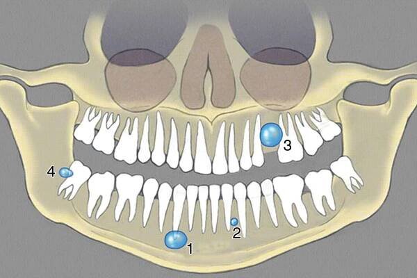 1 = Apical Radicular Cyst, 2 = Lateral Radicular Cyst, 3 = Residual Radicular Cyst, 4 = Paradental Cyst