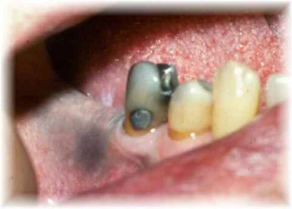 Amalgam_Tattoo_behind_the_last_standing_tooth-518x363-1014x725
