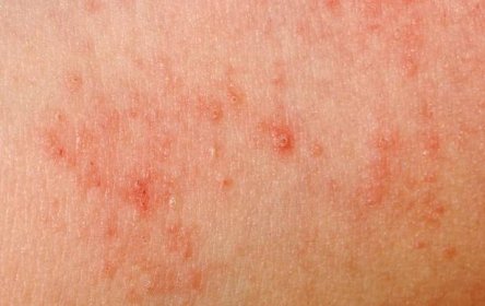 Alergická vyrážka dermatitida kůže textura — Stock fotografie