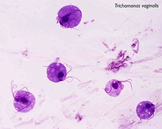 Diagnostika trichomoniózních testů a jejich interpretace / Gonorrhea | Užitečné informace a tipy na péči o sebe. Zdraví