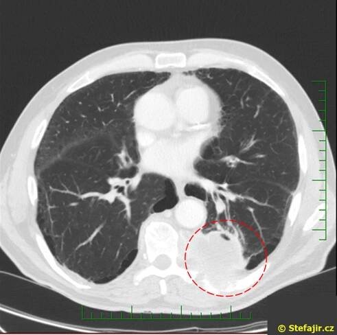 Nález 28 - Tumor plíce postihující žebro | Medicína, nemoci, studium na 1. LF UK