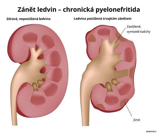 Zánět ledvin - příznaky a léčba