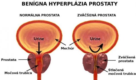 benigní hyperplazie prostaty, zvětšená prostata