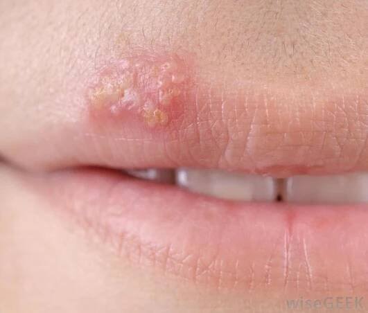 Opar. Pozor! Krustu na oparu nikdy netrhejte, musí sama odpadnout. zdroj: skinhealthbody.com