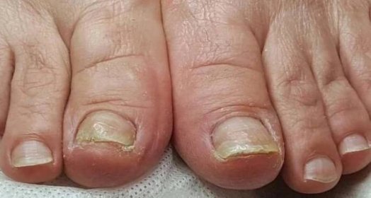 poškození nehtů plísní na nohou