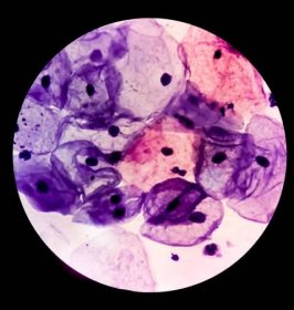 mikroskopický pohled na paps stěr, 100x. lékařský nebo zdravotní koncept. cytologie nebo histologie - skvamocelulární karcinom - stock snímky, obrázky a fotky