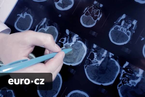 Britští výzkumníci vyvinuli nový test pro diagnostiku mozkových nádorů. Čekání na výsledek zkrátí z týdnů na pouhé hodiny - Euro.cz