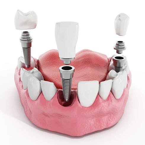 denture implants