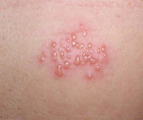 Herpes simplex – prejavy na koži