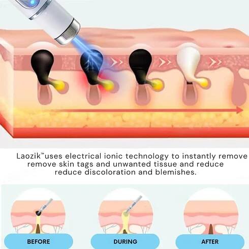 Objevte laserové pero LAOZIK® pro odstranění bradavic pro bezchybnou pleť