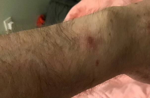 My Apple Watch sensor burns - Apple Community